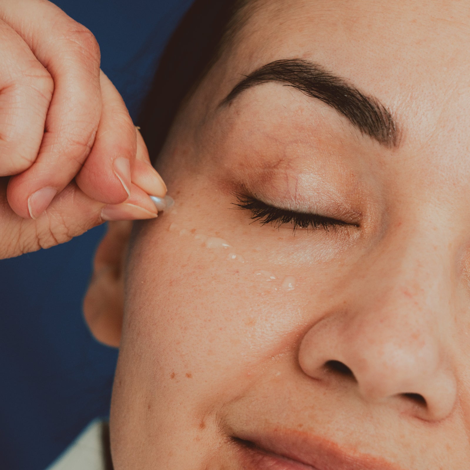 What Are Expression Lines and How Can You Prevent Them?