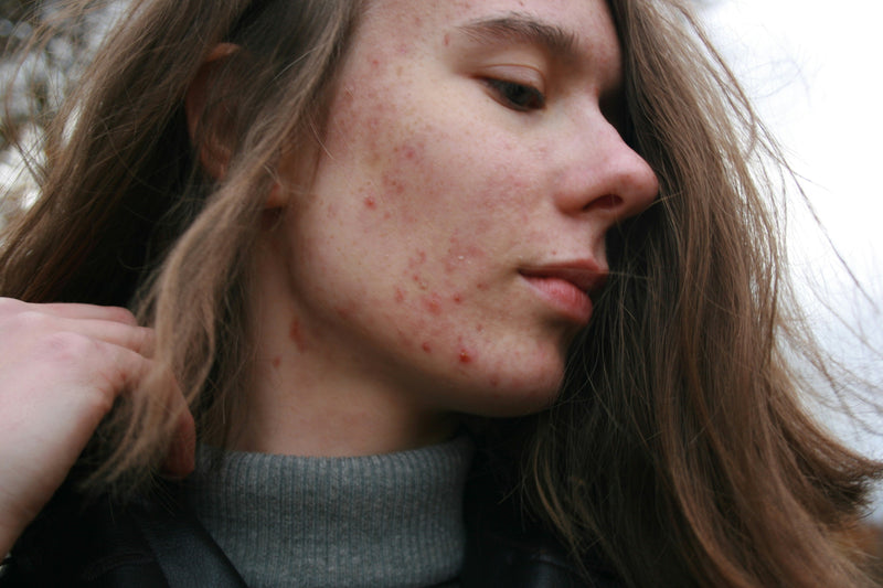 Breaking Out? How to Clear a Blemish + What Not to Do